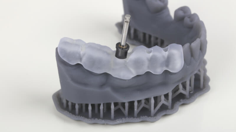 Высокоточная имплантация зубов с хирургическим шаблоном