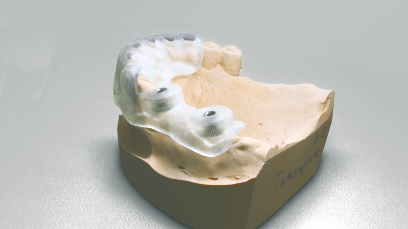 При имплантации зубов мы используем хирургический шаблон