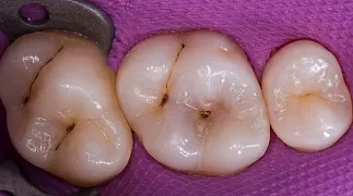 Щадящее лечение кариеса до
