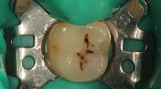 Лечение кариеса жевательных зубов до