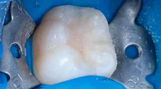 Лечение кариеса жевательного зуба у ребенка 9 лет после