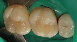 Лечение множественного кариеса после